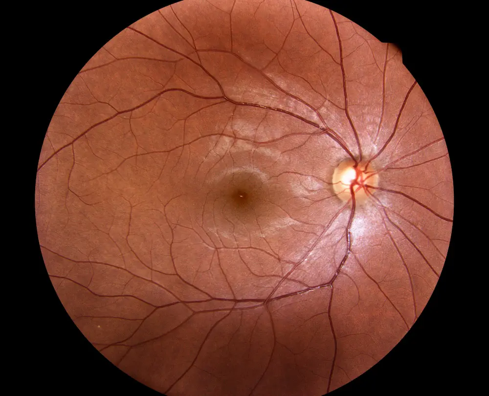 Diabetes Eye Exam: Early Detection Through Eye Exams 2 Diabetic Eye Exam – Retinal Image Showing Blood Vessels And Optic Nerve